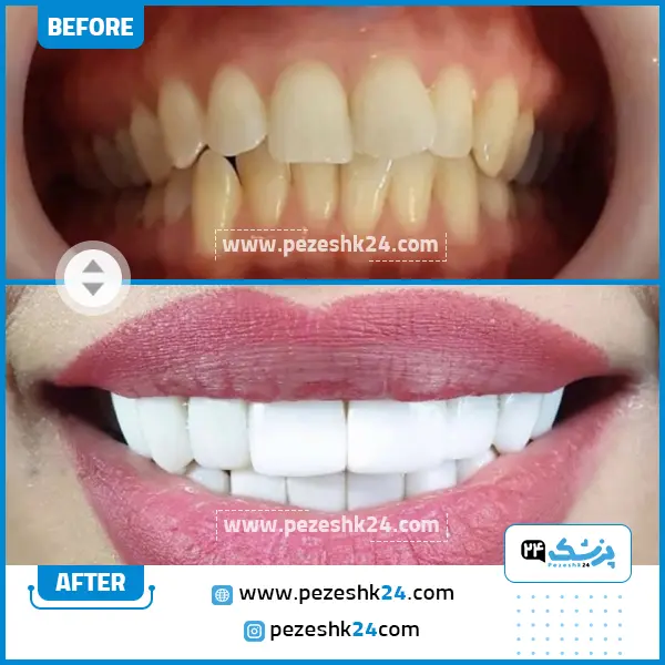 قبل و بعد کامپوزیت دندان کلینیک رازی