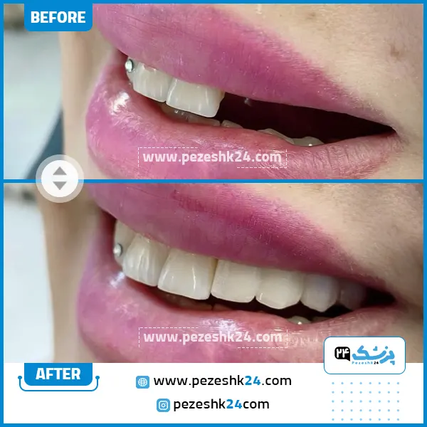 قبل و بعد ایمپلنت دندان کلینیک رازی
