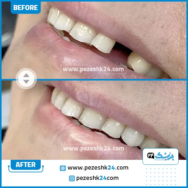 قبل و بعد ایمپلنت دندان کلینیک رازی تهران