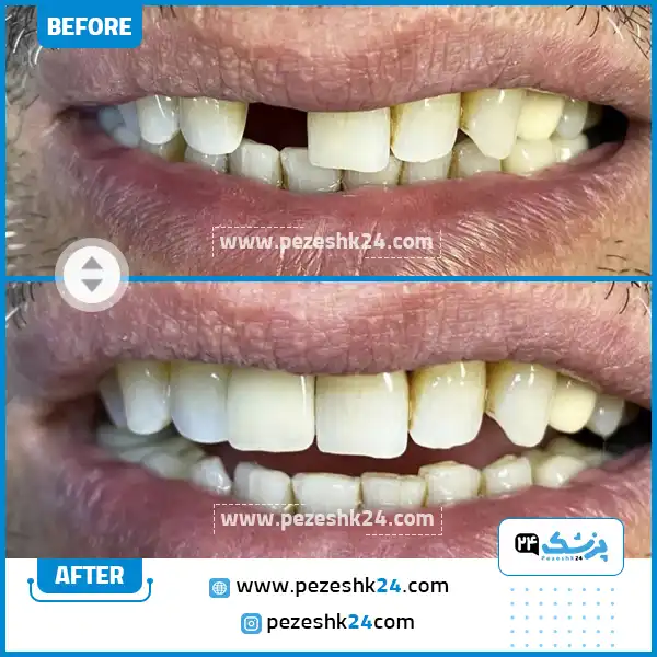 قبل و بعد از ایمپلنت دندان کلینیک رازی