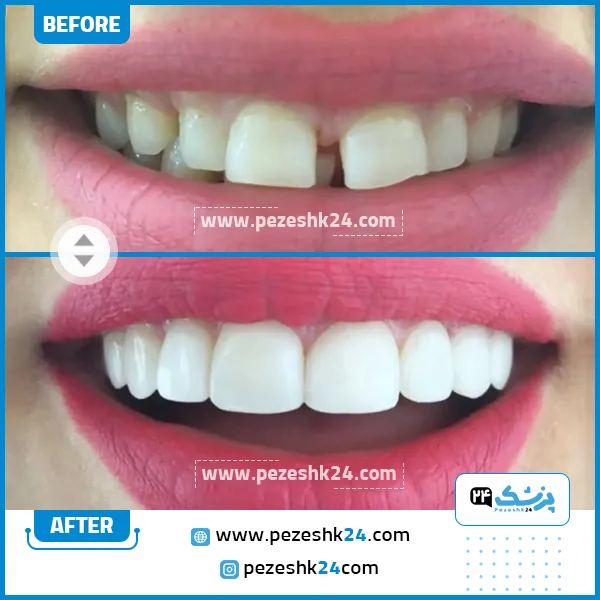 قبل و بعد کامپوزیت دندان کلینیک لاله