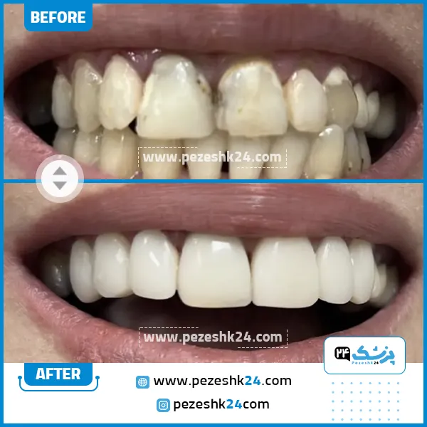 قبل و بعد کامپوزیت کلینیک لاله