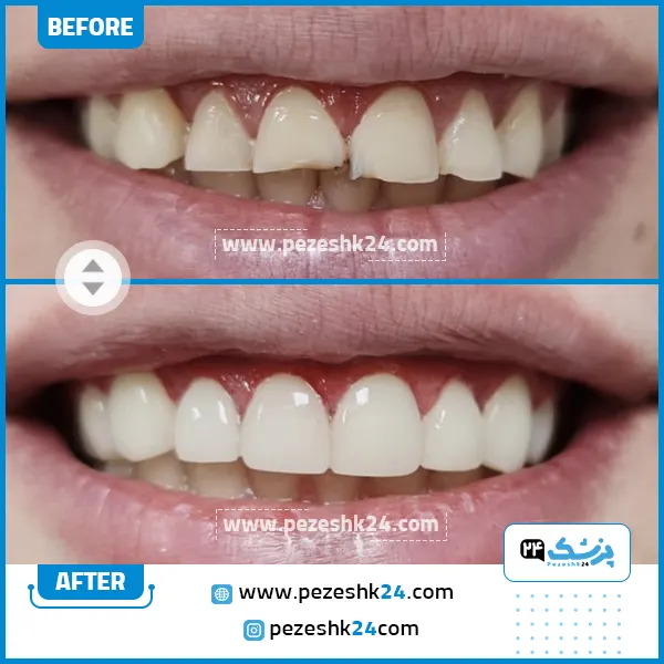 قبل و بعد کامپوزیت کلینیک لاله تهران