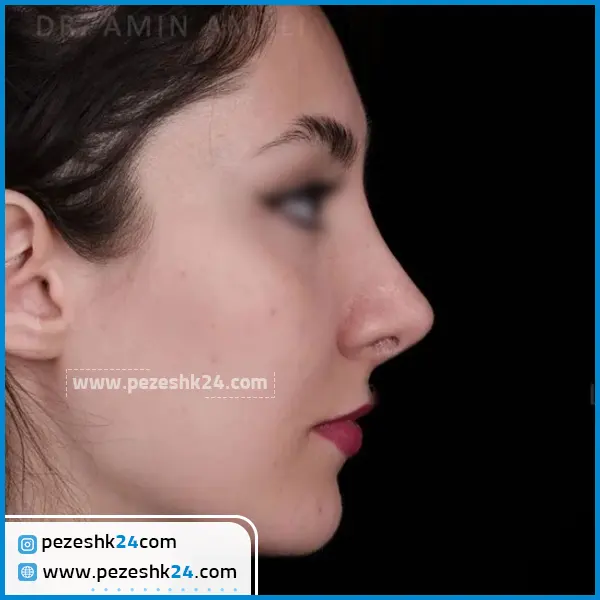 عمل ترمیمی بینی گوشتی