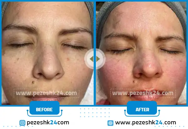 قبل و بعد از میکرو مشهد