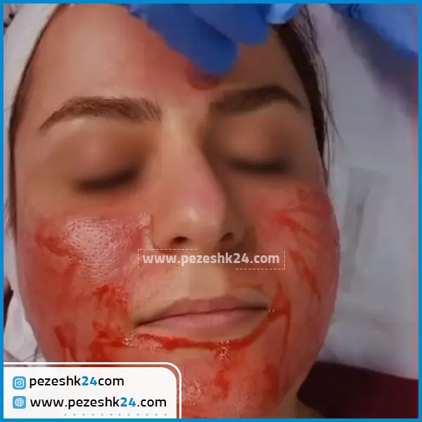 میکرونیدلینگ مشهد