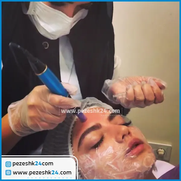قبل و بعد میکرونیدلینگ صورت مشهد