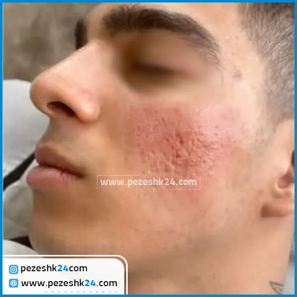 قبل و بعد میکرونیدلینگ صورت در مشهد