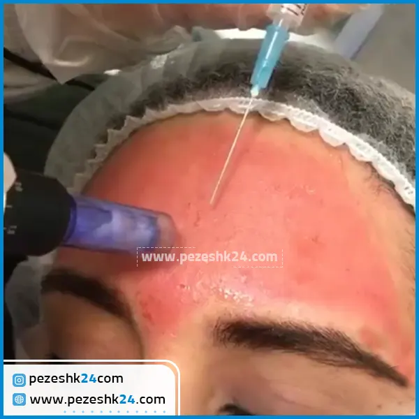 قبل و بعد میکرونیدلینگ