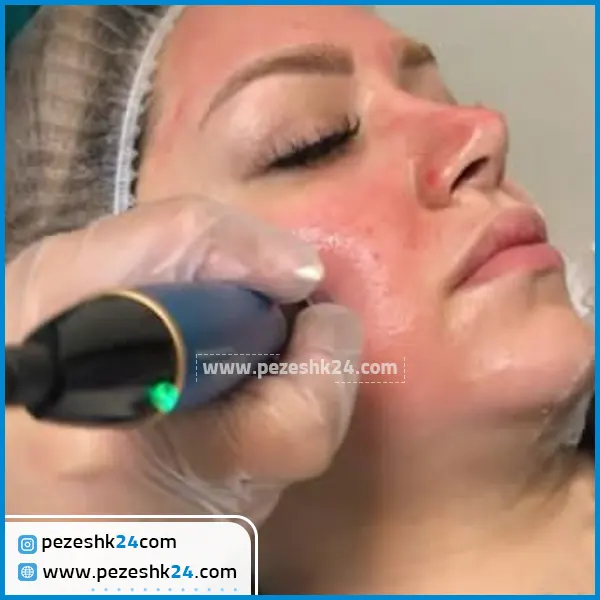 میکروی صورت