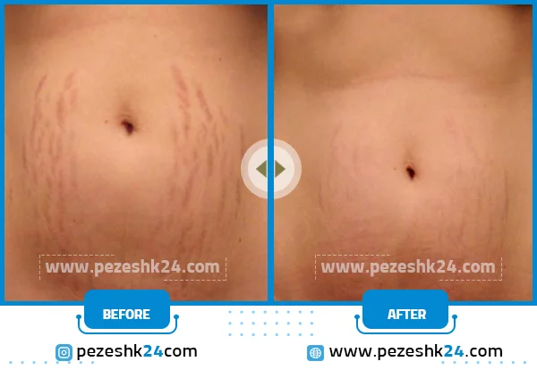 قبل و بعد میکرو در مشهد