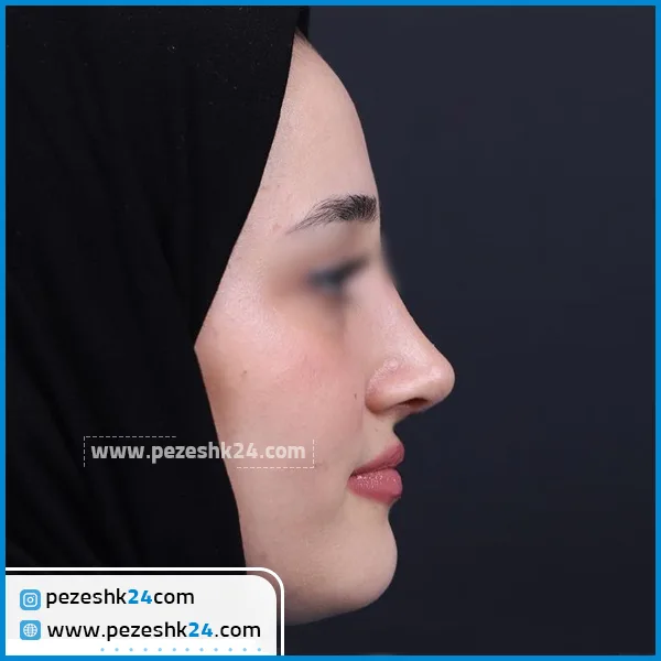 عمل بینی طبیعی زنانه در رشت