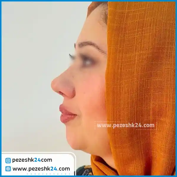 ترمیم بینی در تهران