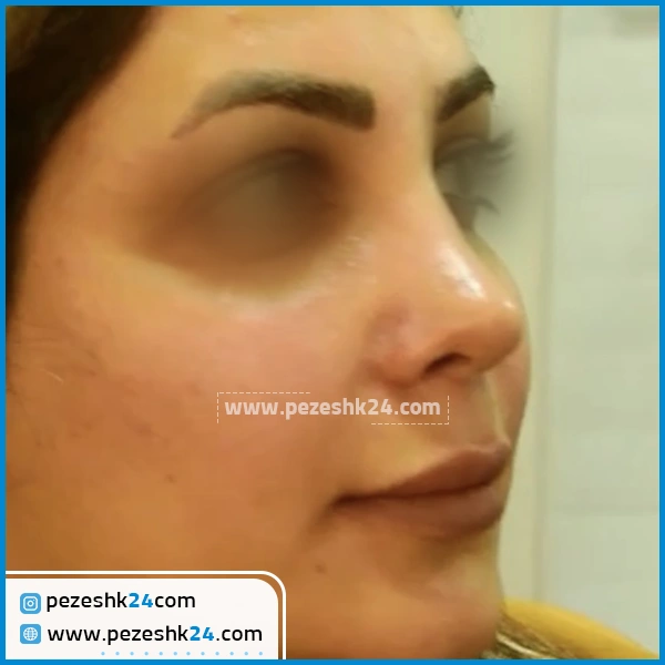عمل ترمیم بینی دکتر فتح سامی