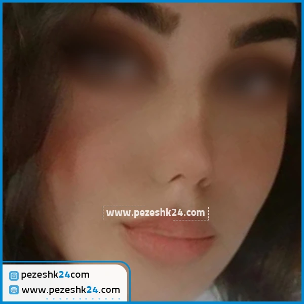 جراحی زیبایی بینی گوشتی دکتر واحدی پور