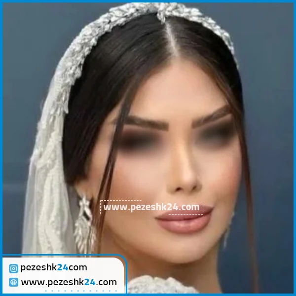 عمل زیبایی بینی دکتر مسلم واحدی پور رشت