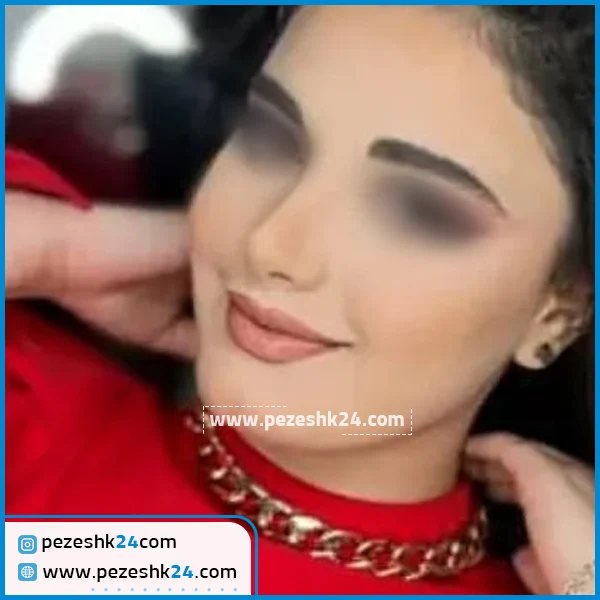 عمل زیبایی بینی دکتر مسلم واحدی پور