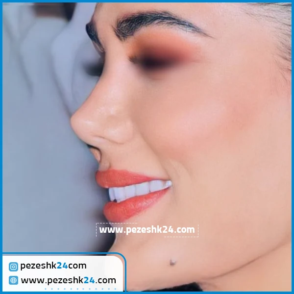 عمل بینی دکتر ونون آصفی شیراز