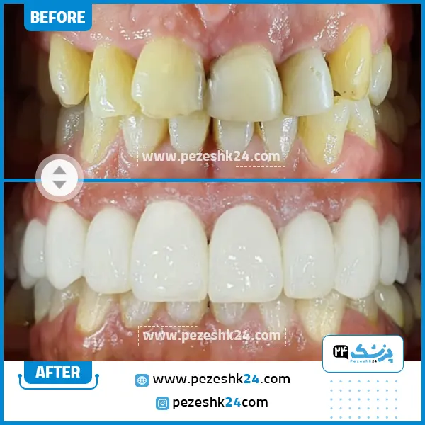 قبل و بعد کامپوزیت کلینیک گیشا