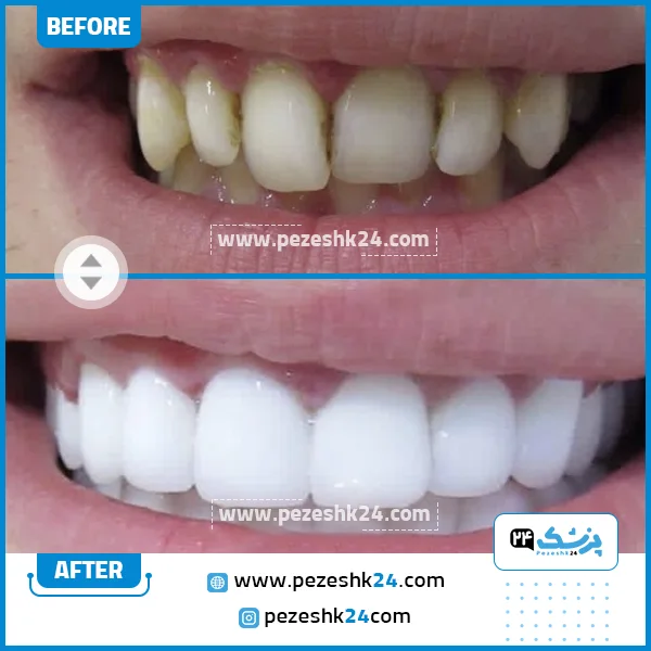 قبل و بعد از کامپوزیت دندان کلینیک گیشا