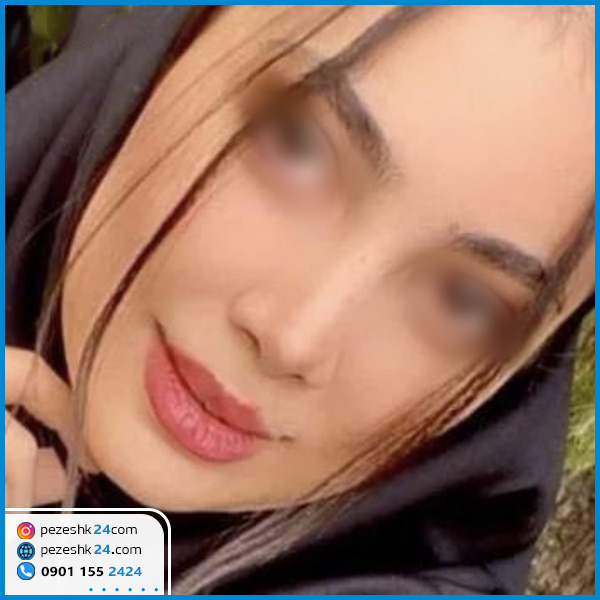 نمونه عمل بینی دکتر خسروشاهی کرمانشاه