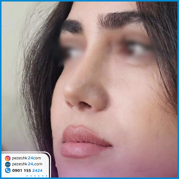 نمونه عمل بینی دکتر محمودی کرمانشاه