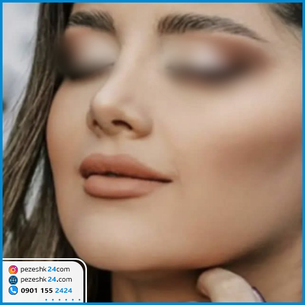 نمونه جراحی بینی دکتر همایون خسروشاهی در کرمانشاه