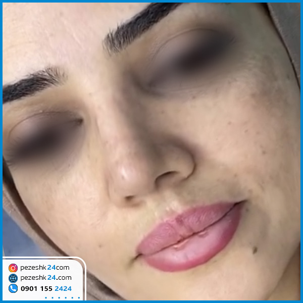 نمونه عمل بینی دکتر رضایی کرمانشاه