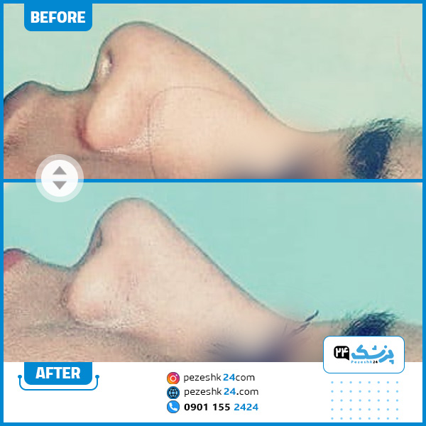 نمونه عمل بینی دکتر محمد باقر حیدری کرمانشاه