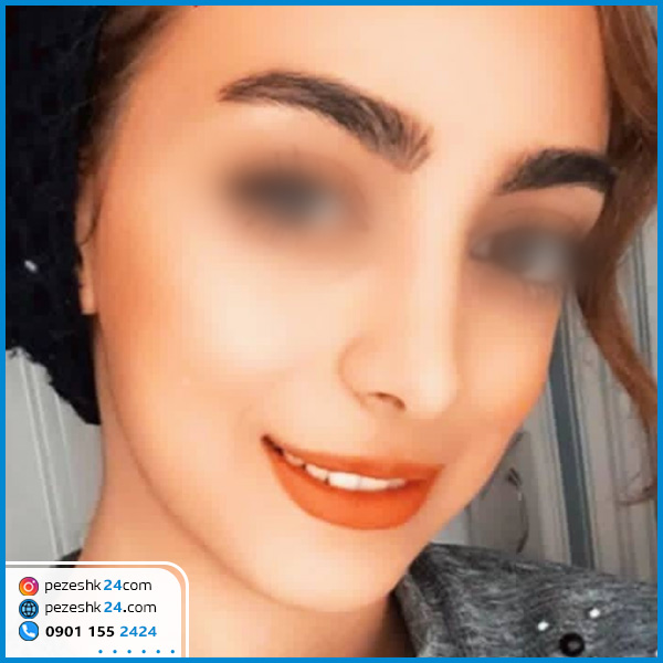 قبل و بعد عمل بینی دکتر بهزاد عزیزی کرمانشاه