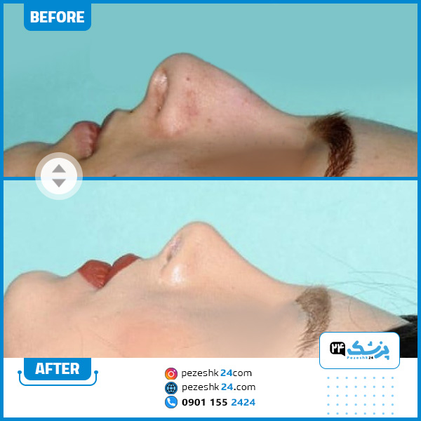 نمونه عمل بینی دکتر مرتضی کریمی کرمانشاه