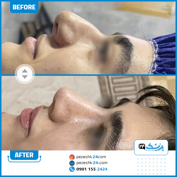 عکس قبل و بعد عمل بینی دکتر دولتی کرمانشاه