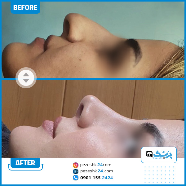 قبل و بعد عمل بینی دکتر بهرام عزیزی کرمانشاه