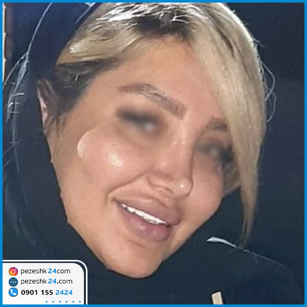 نمونه عمل بینی دکتر همایون خسرو شاهی جراح بینی گوشتی کرمانشاه