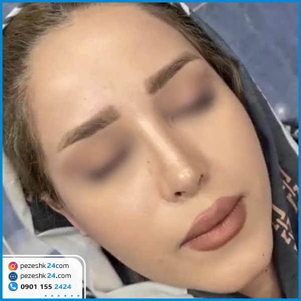 بعد عمل بینی دکتر فرزاد رضایی کرمانشاه