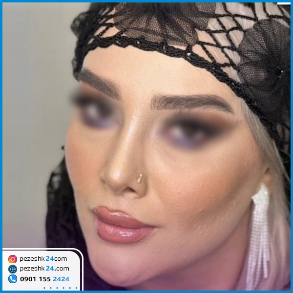 نمونه جراحی بینی دکتر محمودی کرمانشاه
