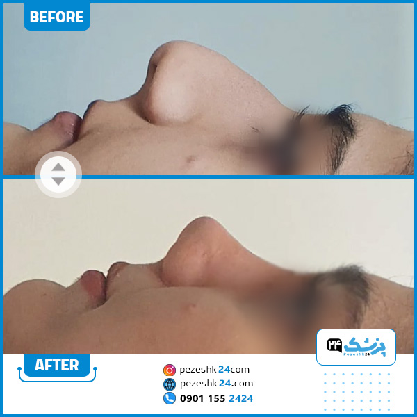 نمونه عمل بینی فانتزی دکتر بهرام عزیزی کرمانشاه