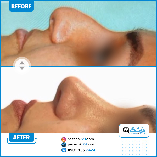 قبل و بعد از عمل دکتر منافی خسروشاهی بهترین دکتر عمل بینی