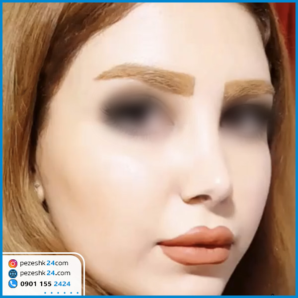 نمونه عمل بینی استخوانی دکتر بهزاد عزیزی کرمانشاه