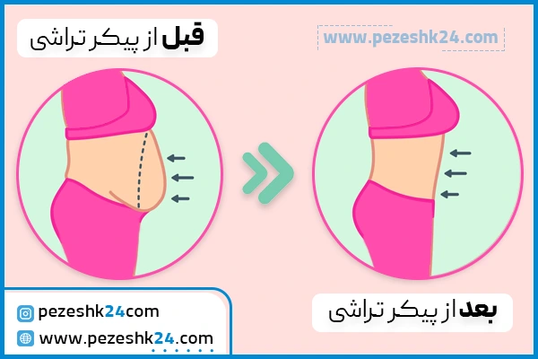 قبل و بعد پیکرتراشی در مشهد