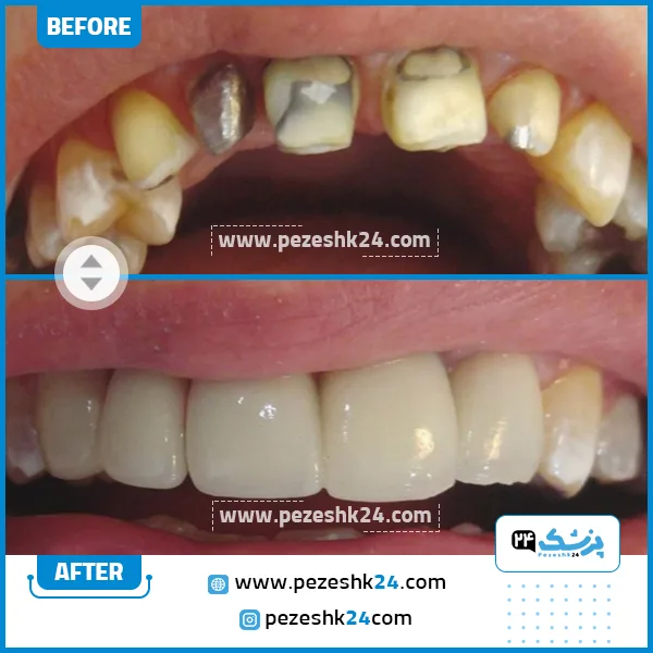 قبل و بعد ایمپلنت دندان کلینیک مهر شریعتی