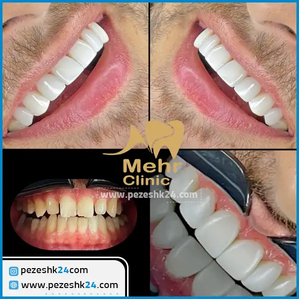 کامپوزیت دندان کلینیک مهر شریعتی تهران