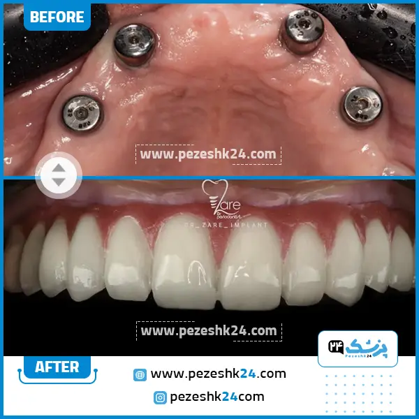 قبل و بعد ایمپلنت دندان دکتر زارع مشهد
