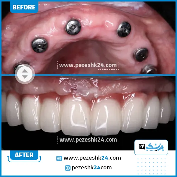قبل و بعد ایمپلنت دندان دکتر زارع