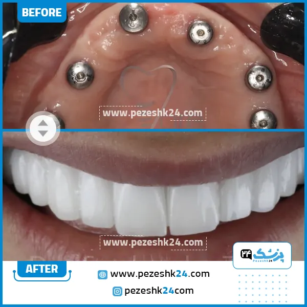 قبل و بعد ایمپلنت دکتر زارع مشهد