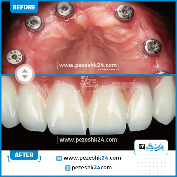 قبل و بعد ایمپلنت دندان دکتر زارع در مشهد
