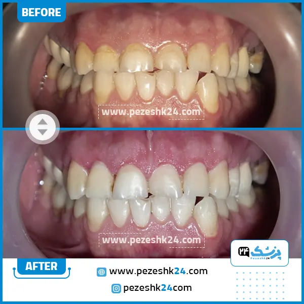 قبل و بعد جراحی لثه دکتر عارفی تهران