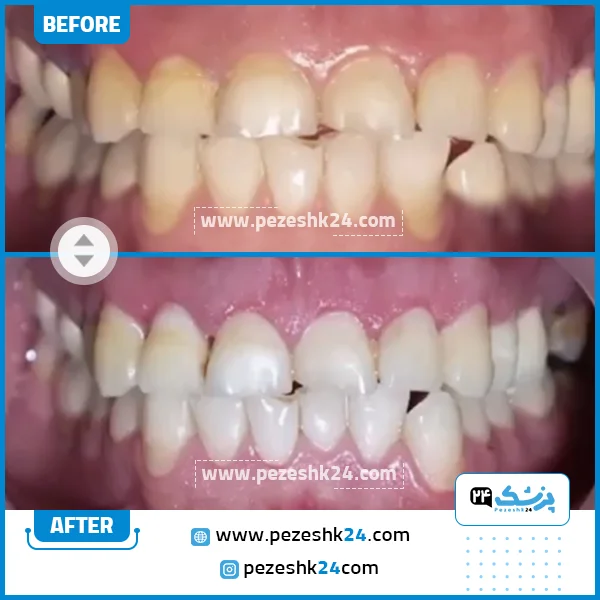 قبل و بعد جراحی لثه دکتر عارفی