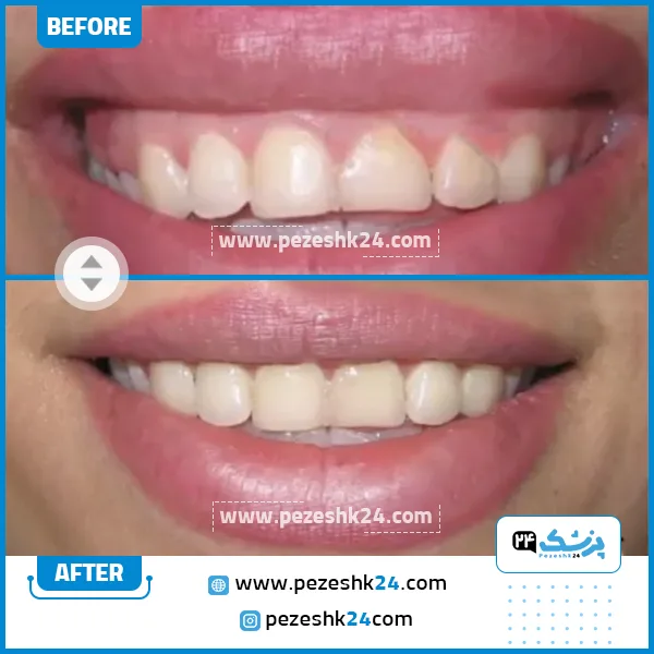 قبل و بعد جراحی لثه دکتر وحید عارفی