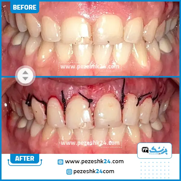 قبل و بعد از جراحی لثه دکتر فائقه فاضلی